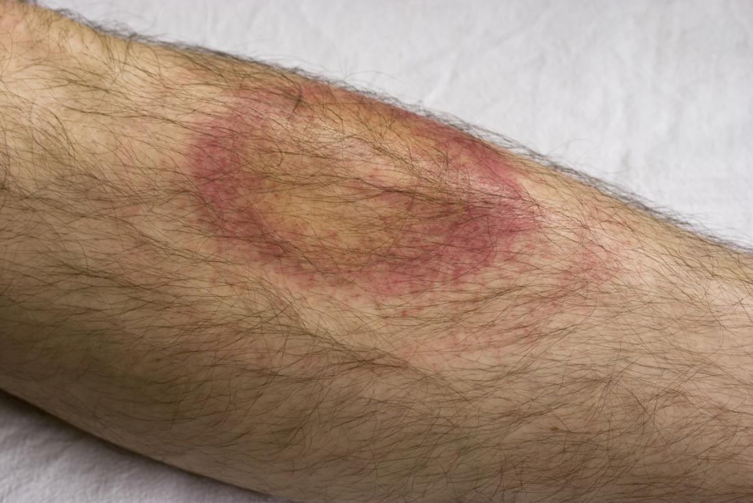 Pennsylvania's Lyme Disease: Asked to avoid Ticks & symptoms of Lyme Disease