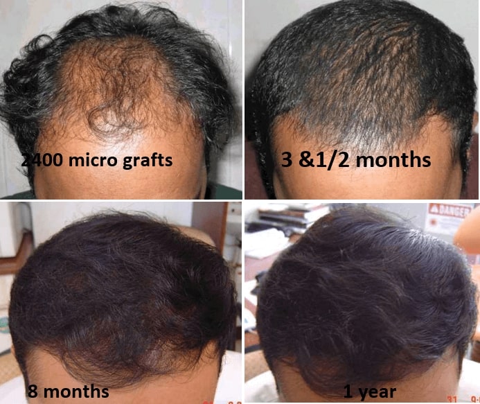 All About FUE Hair Transplant