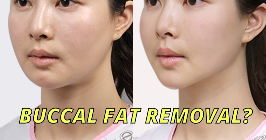 UNDERSTANDING BUCCAL FAT REMOVAL SURGERY